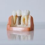 Close-Up Shot of Dental Implant Model