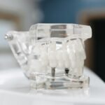 Transparent Dental Implant Model